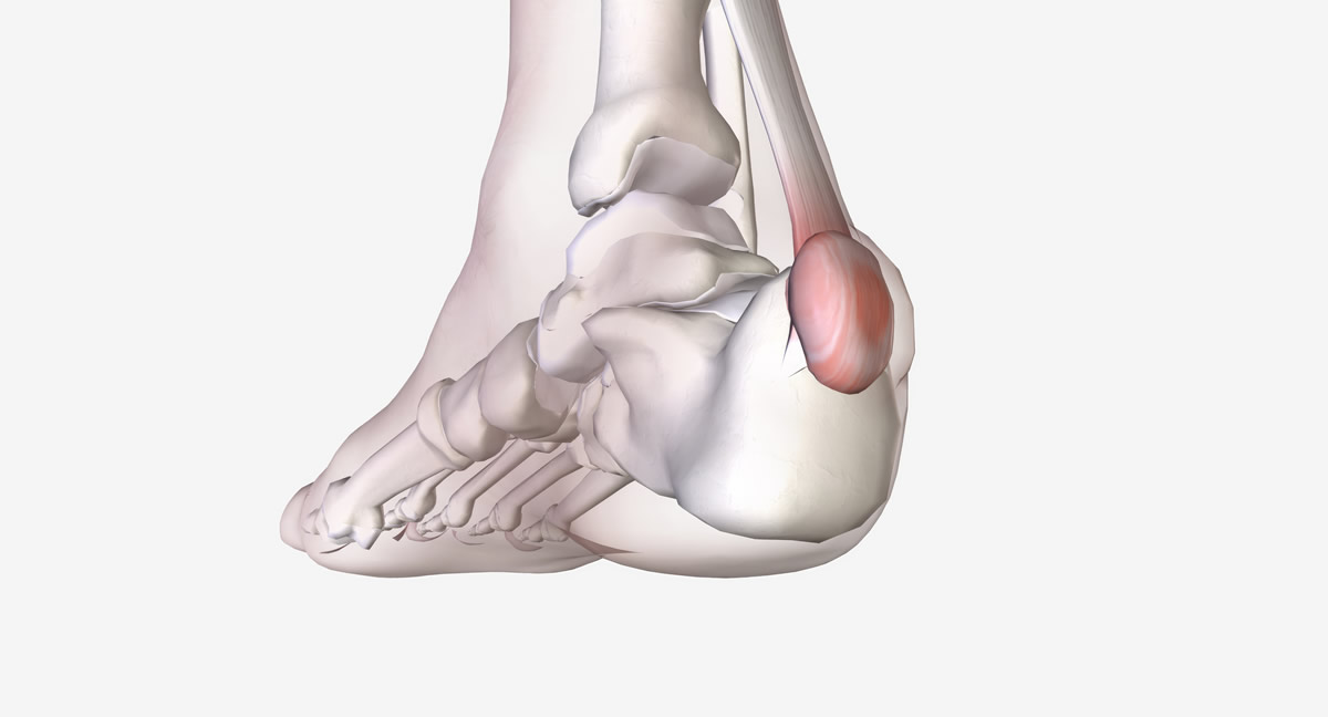 Haglund Deformity Treatment in Goregaon
