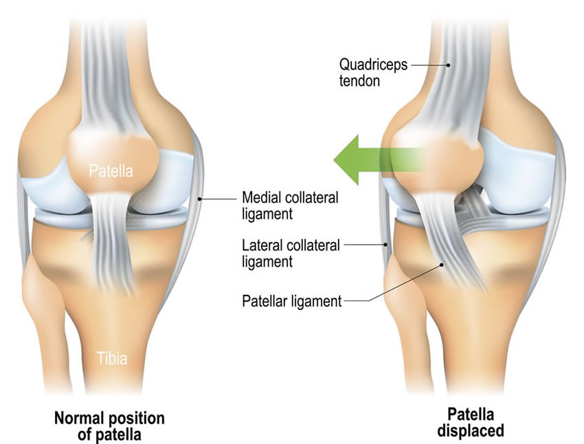 Recurrent patellar dislocation Goregaon