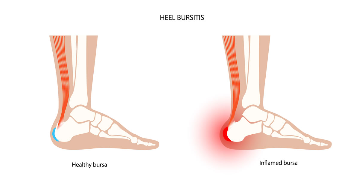 Retrocalcaneal bursitis treatment in Goregaon